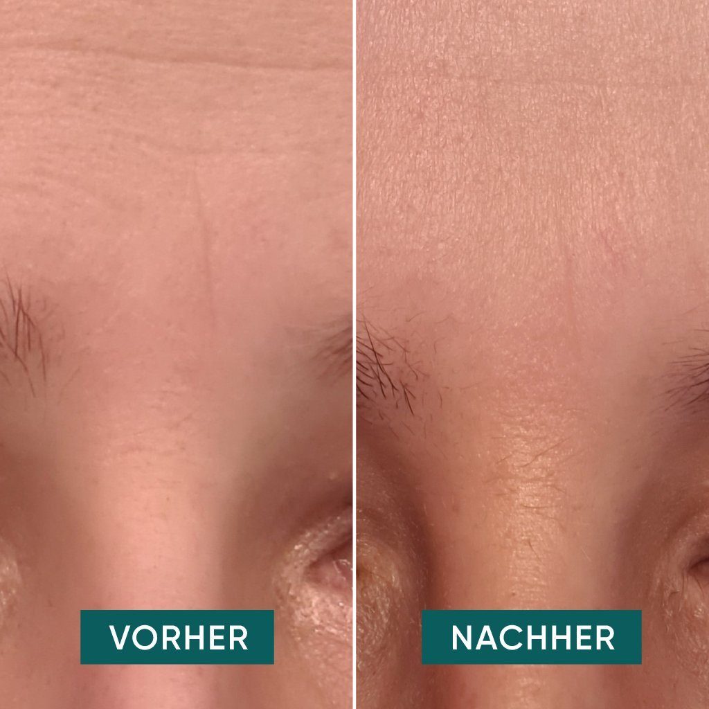 APRICOT Beauty Gesichtsmaske APRICOT® Hyaluron Gesicht Pads 30x wiederverwendbar bei Stirnfalten, Wiederverwendbar