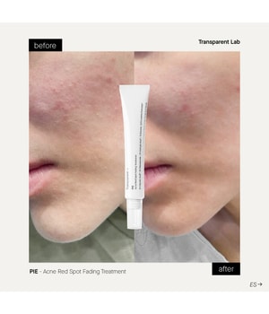 Transparent Lab PIE Acne Red Spot Fading Treatment Gesichtsserum-30 ml