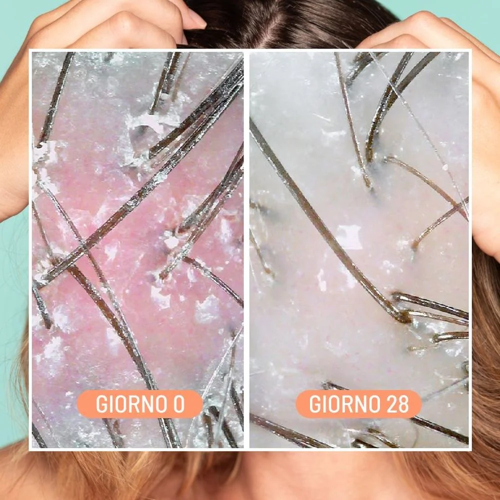 Îngrijirea părului Mătreață și tratament exfoliant pentru scalp - Scrub de păr, Tratament pentru scalp, Tratament anti-mătreață