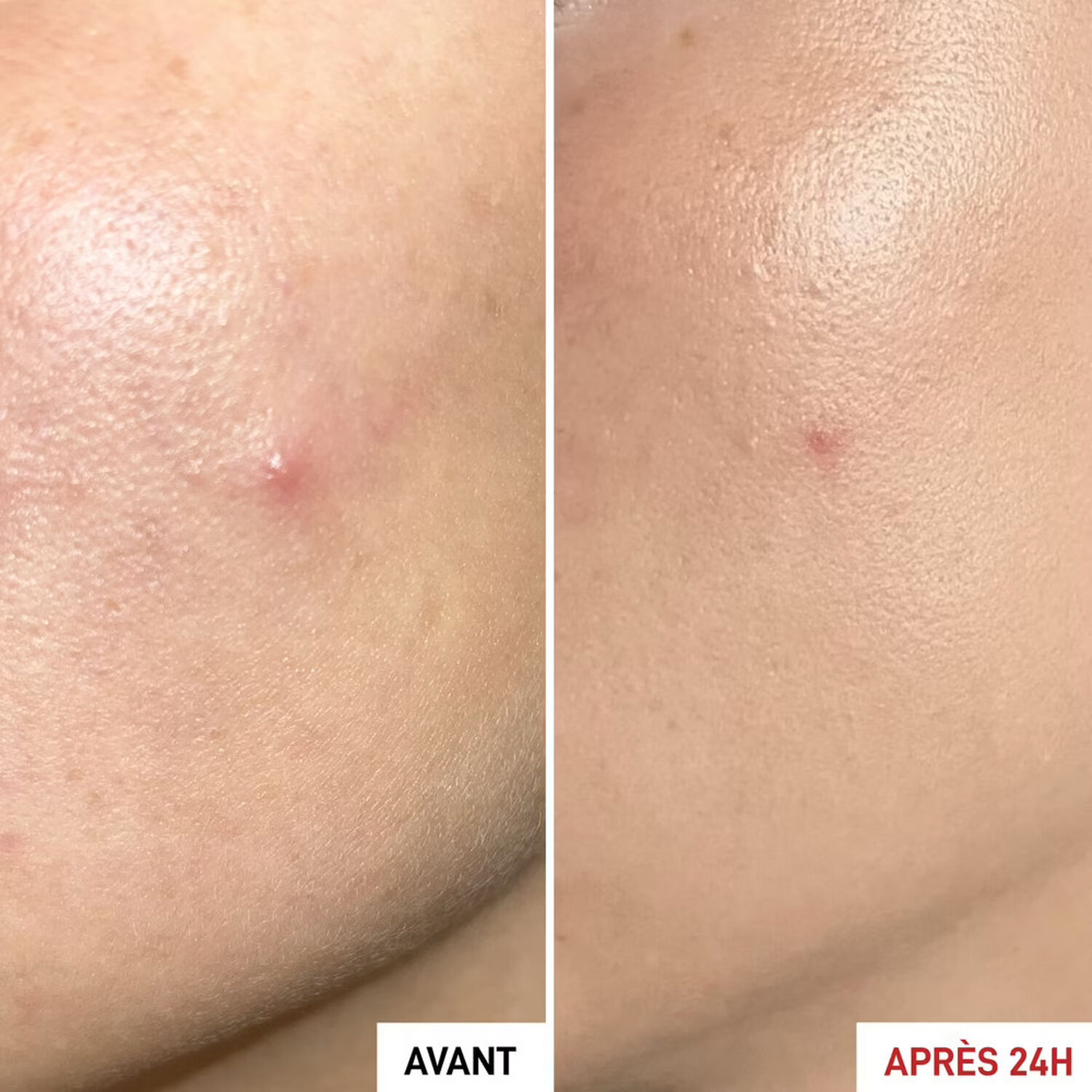 Erborian Centella SOS Patch Soin Ciblé Anti-Imperfections