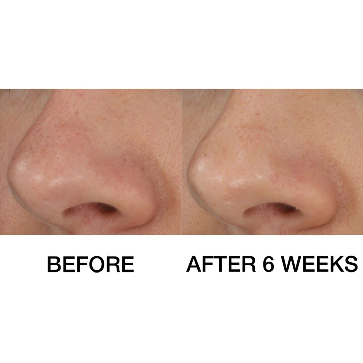 Clinique Blackhead Solutions Αυτοθερμαινόμενο Blackhead Extraxtor Żel oczyszczający