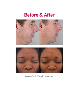 PMD Personal Microderm Pro Blush Microdermabrasion-1 Stk