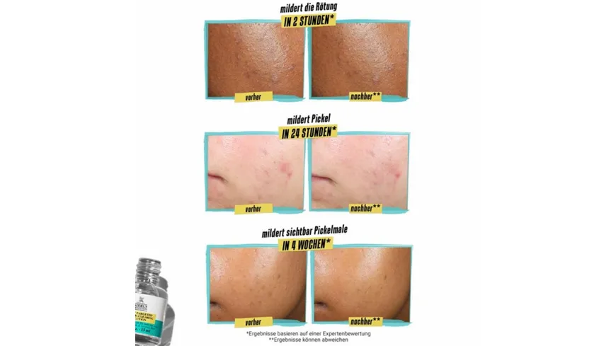 KIEHL'S Truly Targeted Blemish Clearing Solution 15 ml