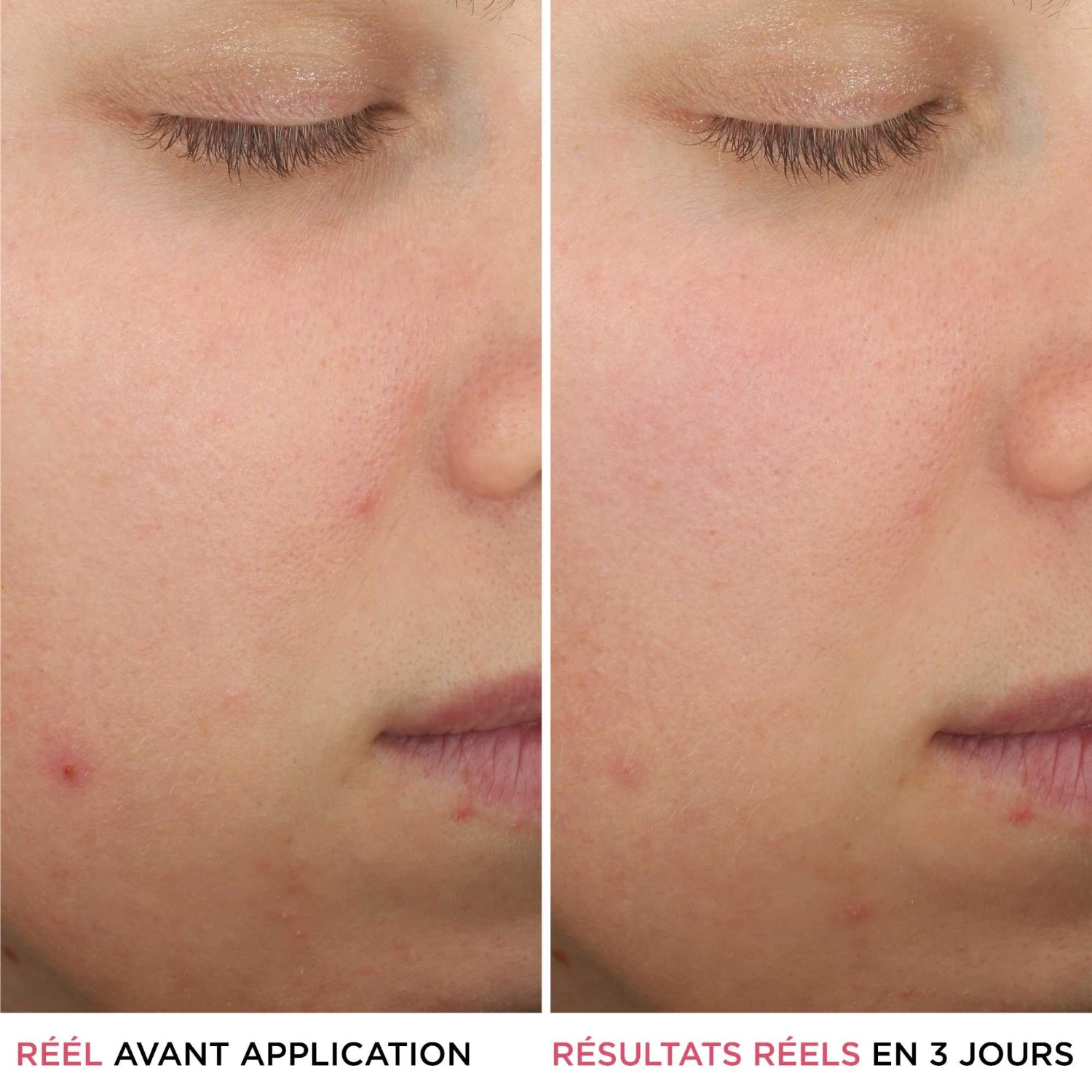 IT Cosmetics Anti-uitslagserum met salicylzuur