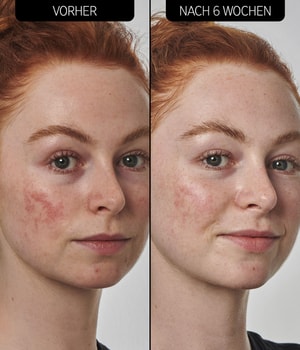 The INKEY List SuperSolutions 10% Azelaic Acid Serum Gesichtsserum-30 ml